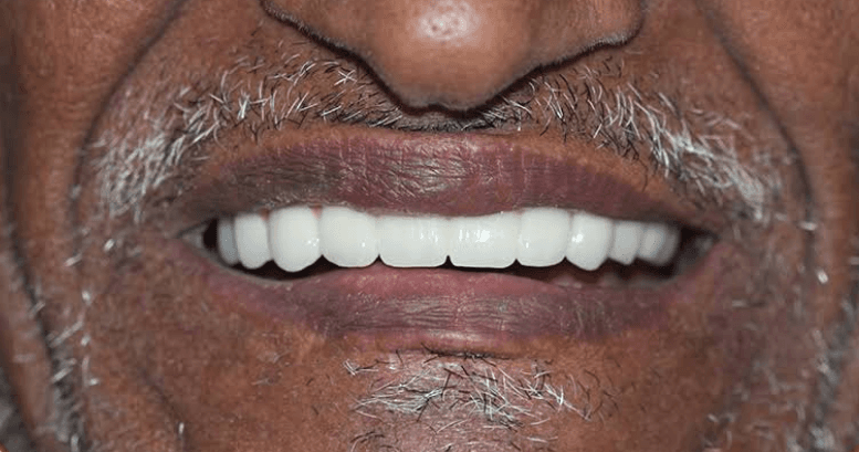 بعد زراعة الأسنان