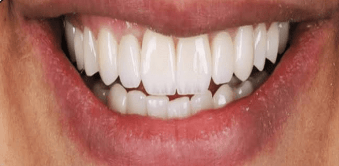 بعد تركيبات الأسنان