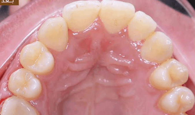 بعد تقويم الأسنان