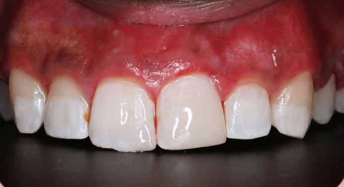 بعد حشوات تجميلية