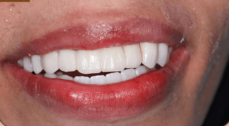 بعد تجميل الأسنان