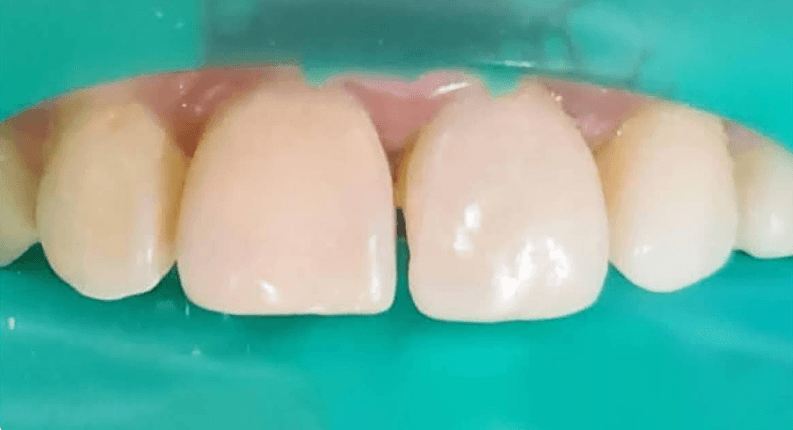 بعد تبييض الأسنان