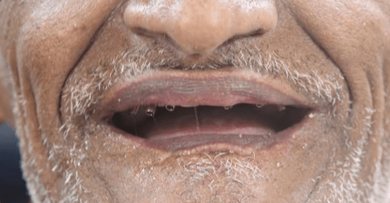 قبل زراعة الأسنان