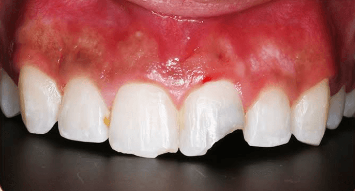 قبل حشوات تجميلية