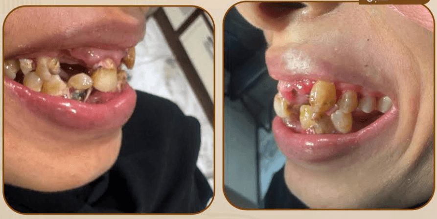 قبل تجميل الأسنان