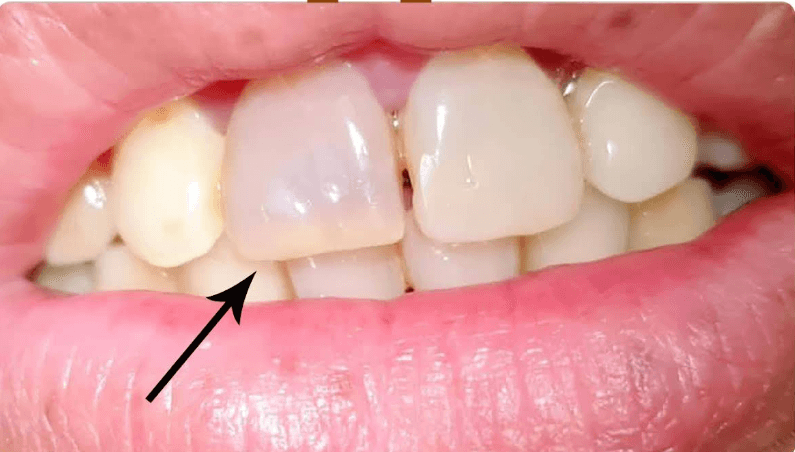 قبل تبييض الأسنان